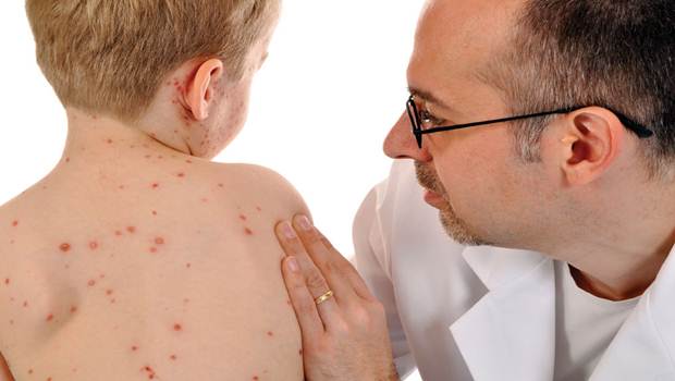 Why doctors are still worried about measles...