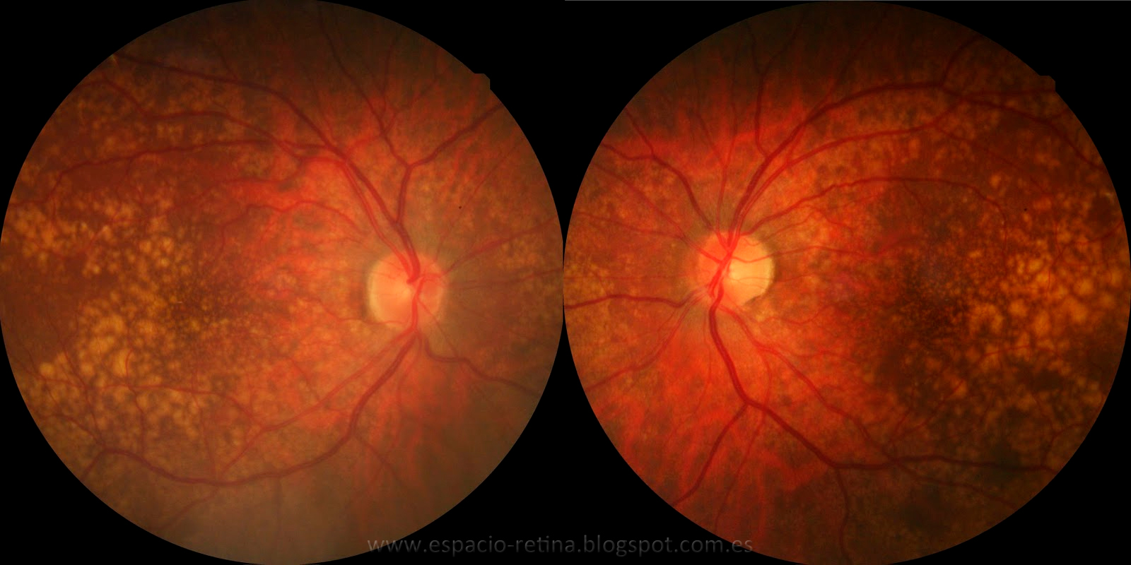 Fabrican células de la retina para regenerar la vista...