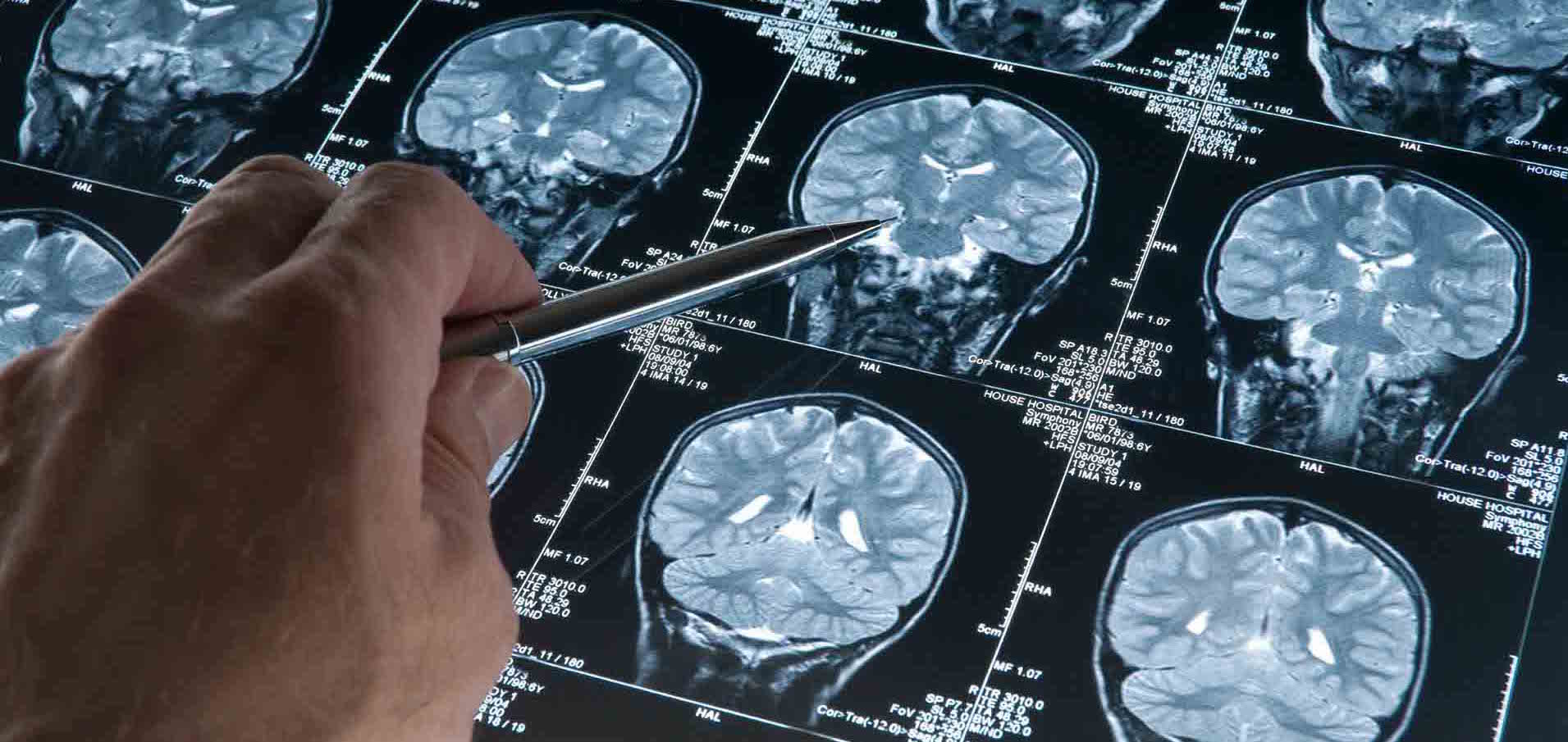 Fármaco evita la muerte de neuronas cerebrales en el alzhéimer...