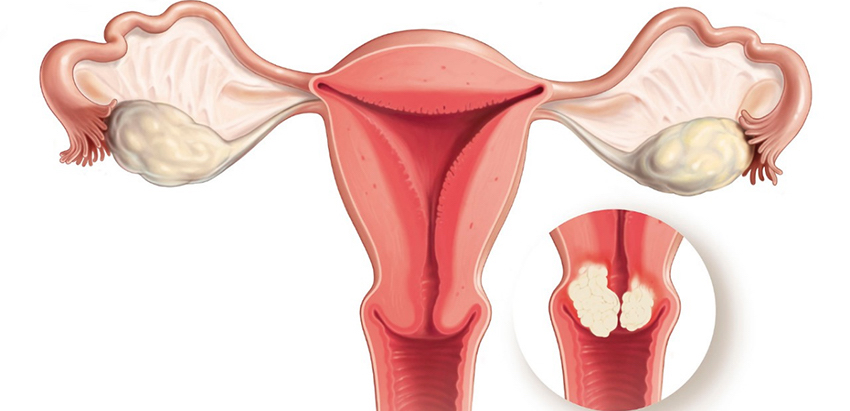 Test para la detección precoz del cáncer de ovario y de útero...