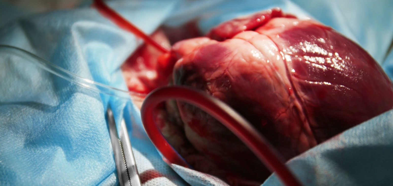 Uso de corazones de cerdos en el trasplante humano...
