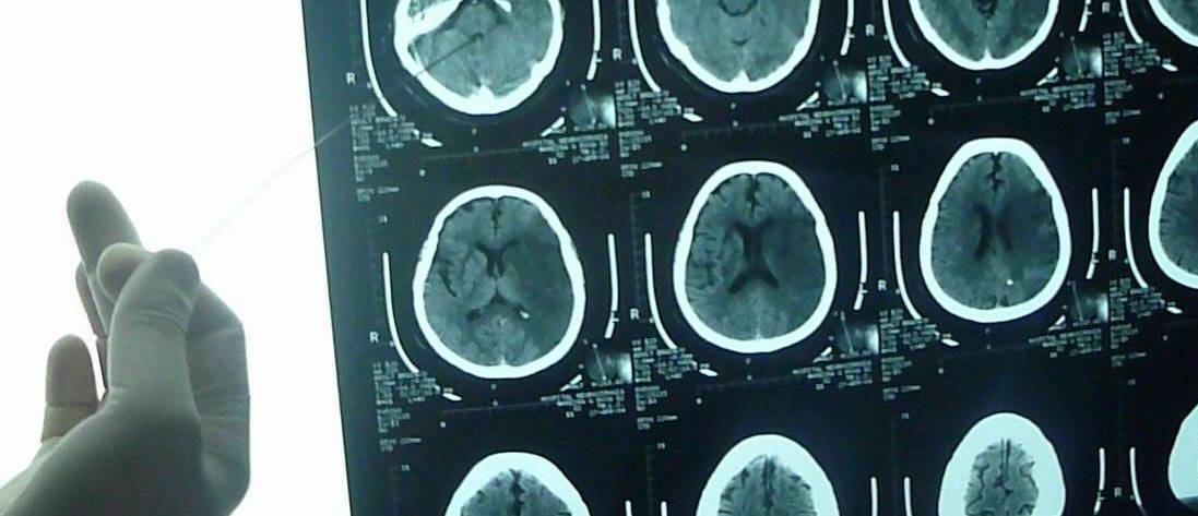 Punción lumbar mejora el diagnóstico del tumor cerebral más agresivo...