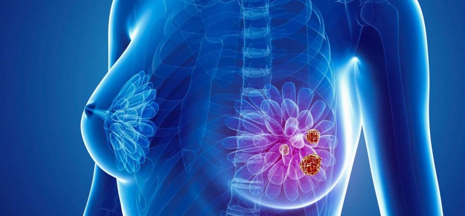 Descubren uno de los mecanismos de resistencia terapéutica del cáncer de mama triple negativo...