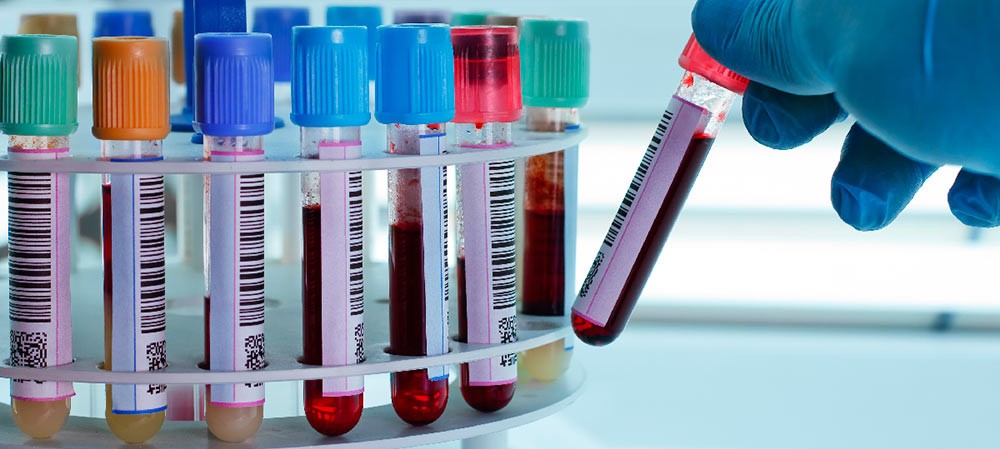 Un nuevo marcador en sangre detecta tres subgrupos de cáncer de mama en estadio inicial...