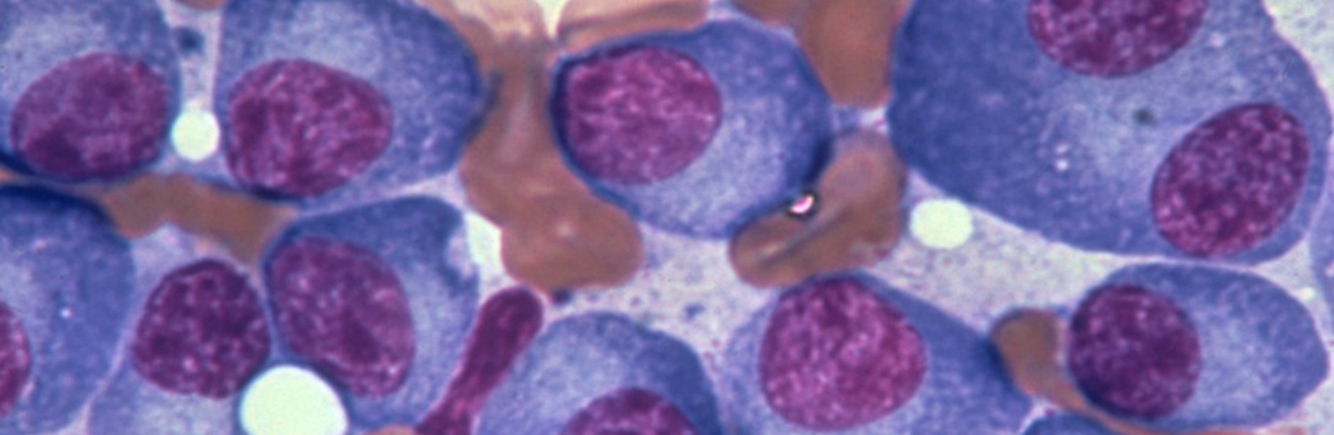 La terapia celular prolonga la supervivencia en mieloma resistente...