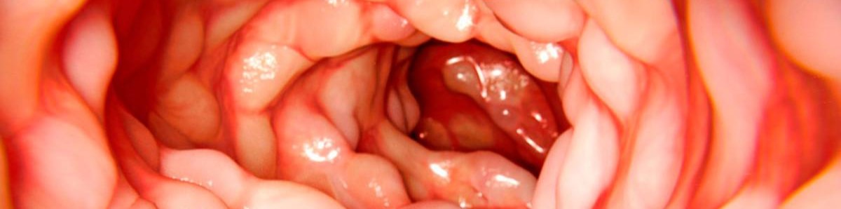 Estimulación del nervio vago, posible tratamiento para el Crohn y la colitis ulcerosa...