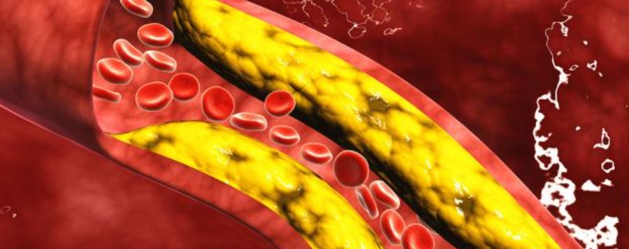 El colesterol bueno baja hasta en un 25% las muertes por covid...