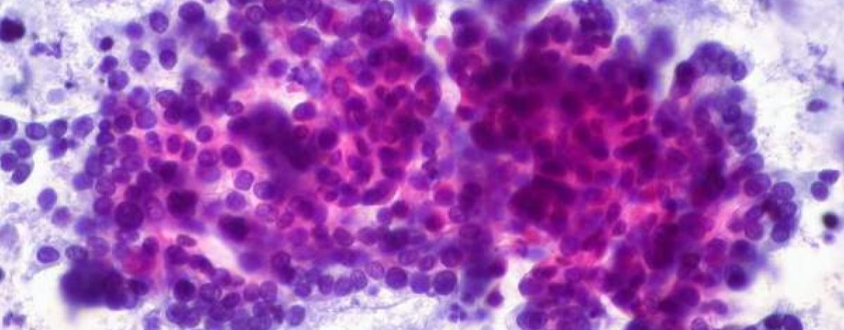 Resultados prometedores de una inmunoterapia basada en las células T de memoria en cáncer de pánc...