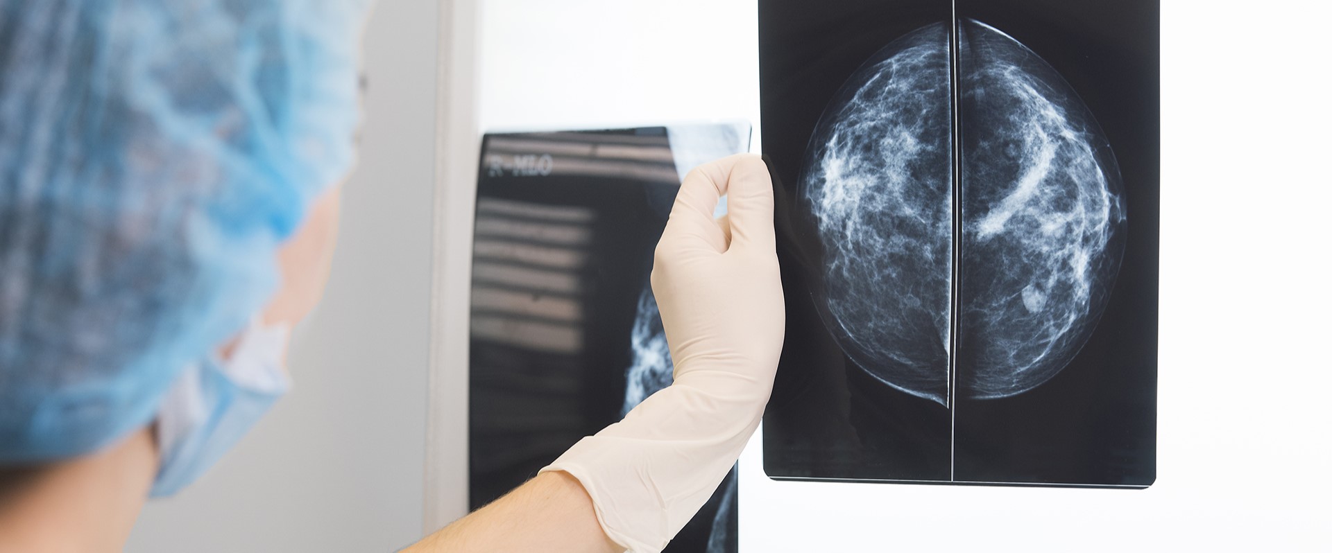 ¿Podrá mejorarse la eficacia de la inmunoterapia contra el cáncer de mama?...