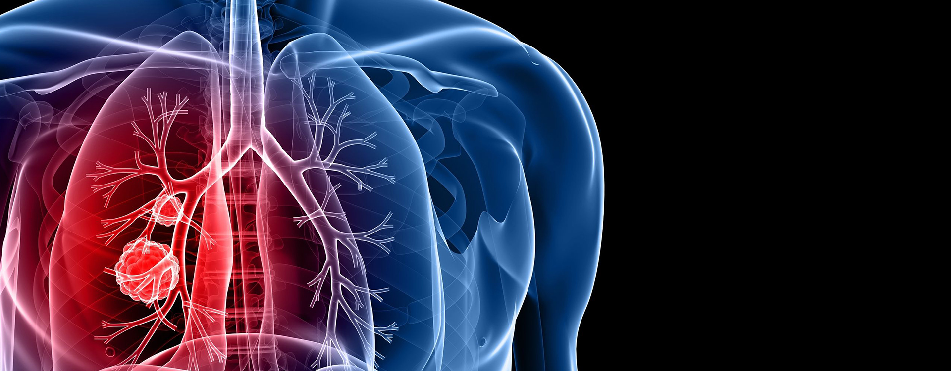 Identificada una nueva diana genética para cáncer de pulmón microcítico...